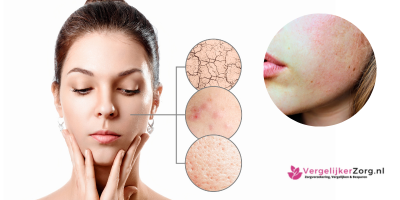 acne-droge-huid
